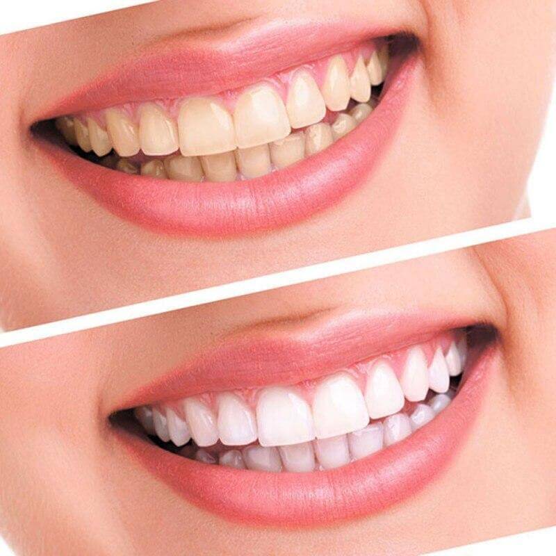 Teeth Whitening Oral Gels - PlanetShopper
